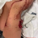 Girl with bite on her leg