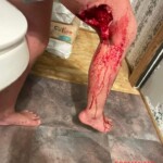 Girl with bite on her leg