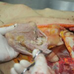 Dissection of stabbed woman