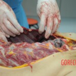Dissection of stabbed woman