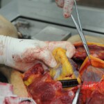 Dissection of stabbed woman