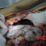 Dissection of stabbed woman