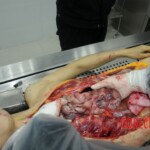 Dissection of stabbed woman
