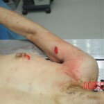 Dissection of stabbed woman