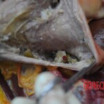 Dissection of stabbed woman