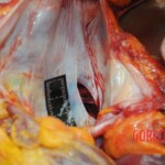 Dissection of stabbed woman