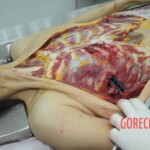 Dissection of stabbed woman