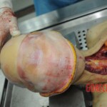 Dissection of stabbed woman