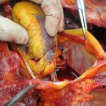 Dissection of stabbed woman