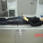 Dissection of stabbed woman