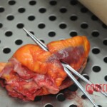 Dissection of stabbed woman