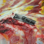 Dissection of stabbed woman