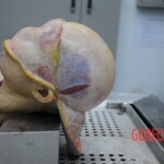 Dissection of stabbed woman