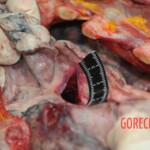 Dissection of stabbed woman