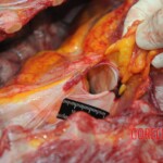 Dissection of stabbed woman