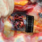 Dissection of stabbed woman