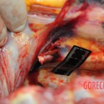 Dissection of stabbed woman