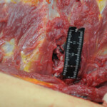 Dissection of stabbed woman