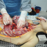 Dissection of stabbed woman