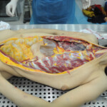 Dissection of stabbed woman