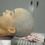 Dissection of stabbed woman