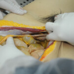 Dissection of stabbed woman