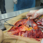 Dissection of stabbed woman