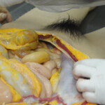 Dissection of stabbed woman