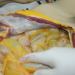 Dissection of stabbed woman