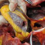 Dissection of stabbed woman