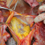 Dissection of stabbed woman