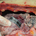 Dissection of stabbed woman