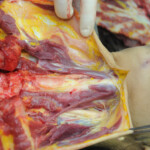 Dissection of stabbed woman