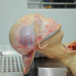 Dissection of stabbed woman