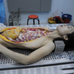 Dissection of stabbed woman