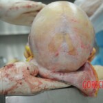 Dissection of stabbed woman