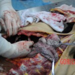 Dissection of stabbed woman