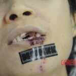 Dissection of stabbed woman