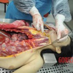 Dissection of stabbed woman