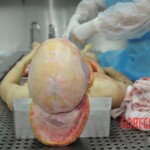 Dissection of stabbed woman