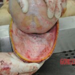 Dissection of stabbed woman