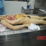 Dissection of stabbed woman