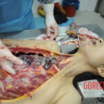 Dissection of stabbed woman