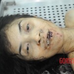 Dissection of stabbed woman