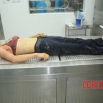 Dissection of stabbed woman