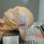 Dissection of stabbed woman