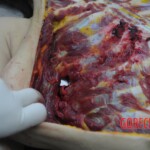 Dissection of stabbed woman