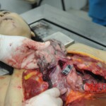 Dissection of stabbed woman