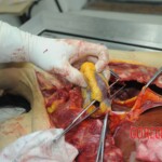 Dissection of stabbed woman