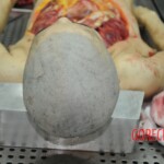 Dissection of stabbed woman